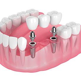 dental bridge being placed on top of two dental implant posts 