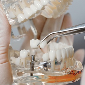 Dentist attaching a crown to a dental implant model